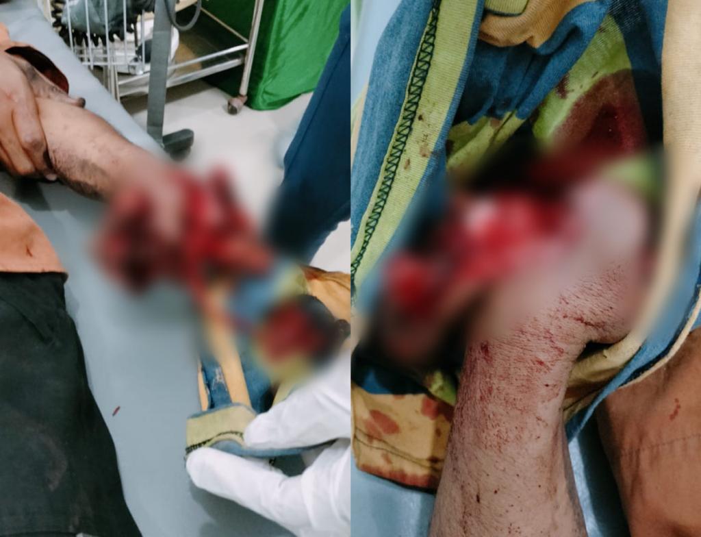 Pria di Konawe Terkena Ledakan Petasan Rakitan, Tangannya Hancur. Foto: Dok. Polresta Kendari.